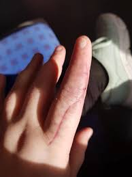 Image result for phlegmon of hand)