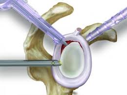 Image result for SLAP Lesion