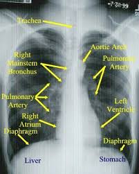 Tips For Reading Chest X Rays A A Normal Chest Film With Landmarks You Should Also Note That The Ri Respiratory Therapy Medical Knowledge Respiratory Care