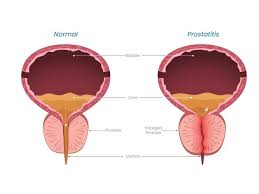 Image result for Chronic Bacterial Prostatitis