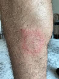 Image result for allergy rash on the legs