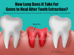 Knowing how to take the necessary precautions before and after the extraction procedure will. How Long Does It Take For Gums To Heal After Tooth Extraction