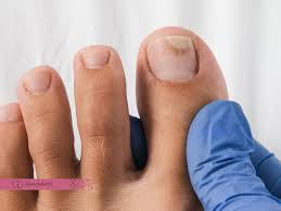 Image result for Onycholysis feet