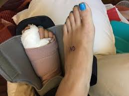 My Bunionectomy Experience Second Foot Surgery Right Foot Foot Surgery Foot Surgery Recovery Bunion Surgery