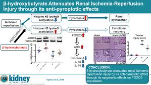 Renal cyst is a generic term commonly used in description of any predominantly cystic renal lesion. B Hydroxybutyrate Attenuates Renal Ischemia Reperfusion Injury Through Its Anti Pyroptotic Effects Kidney International
