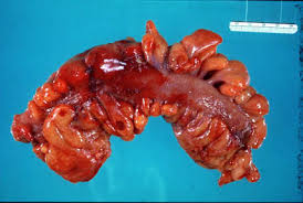 Image result for Diverticulitis