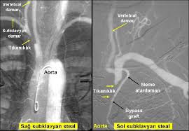 kol damari tikanikliklari