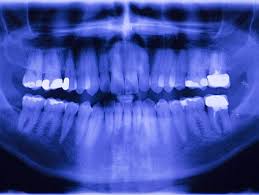 In the case of standard procedures, there is no or negligible chance of risk. Digital X Rays Safe Or Unsafe Thomas F Brown Dds