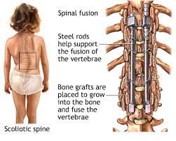 How long does scoliosis surgery take. Scoliosis Surgery Who Does And Doesn T Need It