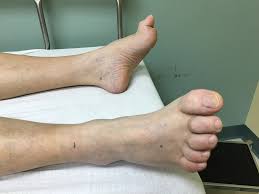 How to straighten crooked toes without surgery. Hammer Toe Wikipedia