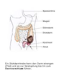 Ist der darmverschluss sofort in die klinik gebracht worden? Darmverschluss Ileus Eesom Gesundheitsportal