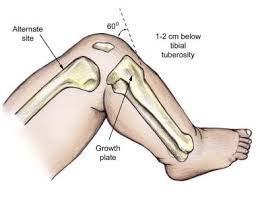 Image result for Difficult Intravenous Access in Children