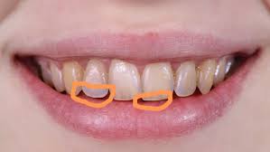 門牙咬合區域變得有點白白的 - 牙齒矯正板 | Dcard
