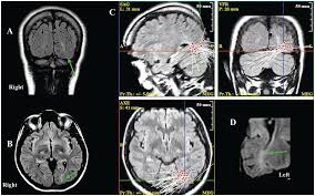 Maybe you would like to learn more about one of these? Neuroimaging In Epilepsy Chapter 17 Understanding Epilepsy