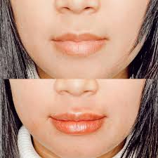 𝓟𝓻𝓸𝓯𝓲𝓵𝓮 𝓔𝓷𝓱𝓪𝓷𝓬𝓮𝓶𝓮𝓷𝓽 ✨ a little bit of filler can go a  long way- this patient was experiencing volume loss in her cheeks & needed  just a little refreshing! Subtle enhancements make the