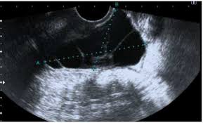 benign mesothelioma of the appendix: Multicystic Benign Mesothelioma Complicating Pregnancy