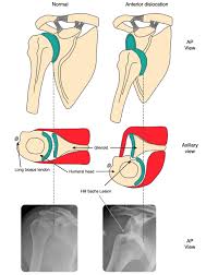 Image result for Chronic Shoulder Dislocation