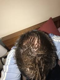 Posts and comments that could be construed as highly controversial or. Topical Dutasteride Saved My Hair T Replacement Forums T Nation