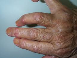 Maybe you would like to learn more about one of these? Rheumatoid Arthritis And The Skin Dermnet Nz