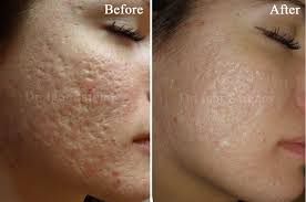 Ich erkläre euch microdermabrasion und zeige am beispiel wie die behandlung angewendet wird. Microdermabrasion Test Kaufmannsund Vergleich Kaufe Den Besten Microdermabrasion Testsieger Bis Nach 70 Gunstiger Microdermabrasion Kaufempfehlung Vor Microdermabrasion Vergleich