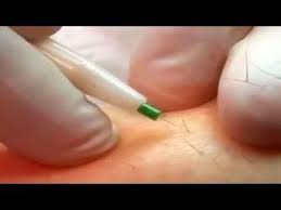 Learn about the differences between electrolysis vs laser hair removal based on procedure, session, benefits, side effects, cost, effectiveness and aftercare. Best Home Electrolysis Machine To Buy 2021 Detailed Review My Beard Gang