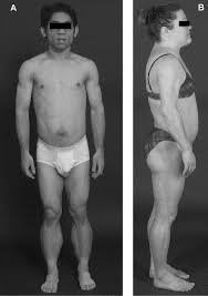 It is a type of lipodystophy disorder where the magnitude of fat loss determines the severity of metabolic complications. Lipodystrophies Rare Disorders Causing Metabolic Syndrome Endocrinology And Metabolism Clinics