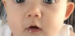 bebeklerde kepce kulak probleminde bant kullanimi ankara cocuk doktoru klinigi