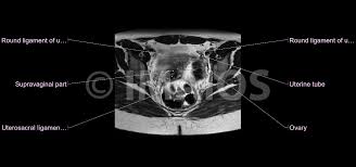 We created an anatomical atlas of abdominal and pelvic ct which is an interactive tool for studying the conventional anatomy of the normal structures based on a multidetector computed tomography. Mri Of The Female Pelvis