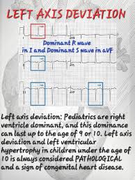 Image result for Right Axis Deviation