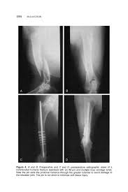 Internal Fixation