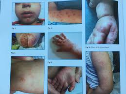 Je l'ai blindé de doliprane. Syndrome Pieds Mains Bouche Qu Est Ce Que C Est Pediatre Online