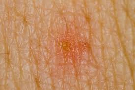 Image result for scabies human bites