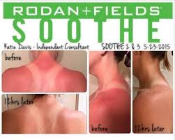 It S That Time Of Year When A Sunburn Is Almost Inevitable Be Sure To Have Our Soothe On Rodan And Fields Soothe Sunburn Remedies Natural Remedies For Sunburn