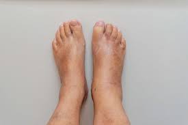 How To Get Rid Of Swollen Ankles Fast: Home Remedies