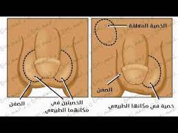 الخصية المعلقة عند الأطفال خطير جدا youtube