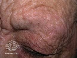 Image result for Lichen Simplex Chronicus