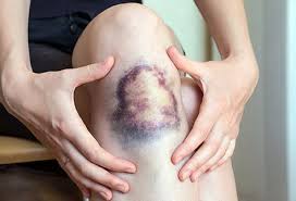 Place the whole bag of veggies on your bruise for 10 minutes at a time to ease the pain, just like you would with ice. Bruises Stages Causes Easy Bruising How Long Do They Last