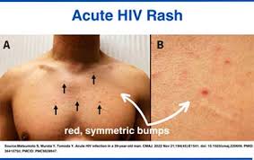 Image result for skin rash acute hiv infection