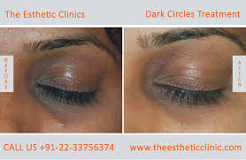 Dark Circle Treatment Mumbai Under Eye Dark Circle Removal Cost India The Esthetic Clinics