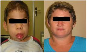 Expression of the disease