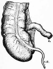 Check spelling or type a new query. Appendicitis O Apendisitis Ano Sanhi Sintomas Lunas Gamot Paano Maiwasan Signs Symptoms