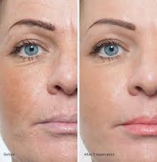 Chemical Peels Microdermabrasion Facials Chicago Schaumburg Naperville Microdermabrasion Erase Wrinkles Skin Needling