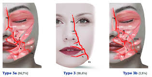 3 Type 3 forehead pattern and subtypes 3a and 3 b.