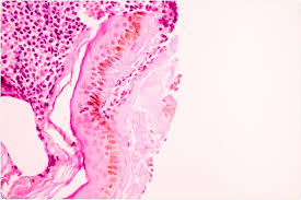 Breast cancer multiparameter gene expression tests. New Type Of Immune Cell Discovered In Breast Ducts