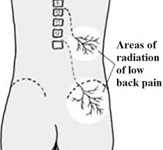 Warning signs of more serious injury include pain with coughing or urinating, loss of control of the bowels or bladder, new leg weakness, and fever. Treating Low Back Pain Hubpages