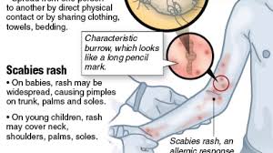 Image result for scabies symptoms