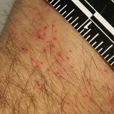 Image result for bedbugs bites