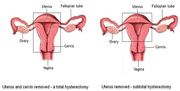Why Laparoscopic Surgery (TLH with Morcellation) Carries Specific Risk
