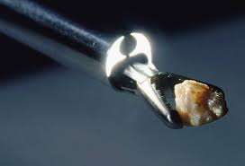 What does passing a kidney stone feel like? Kidney Stone Pictures Symptoms Causes Treatments And Passing Stones