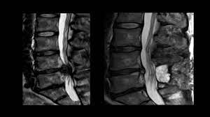 Cauda Equina Syndrome Physiopedia